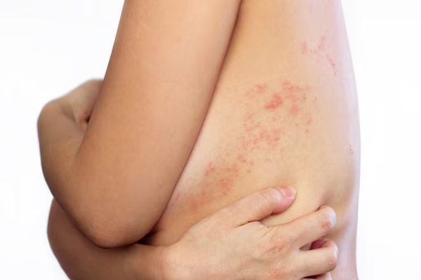 imagen del lateral de la zona media del tronco de una mujer con sarpullido y ampollas producidas por el virus