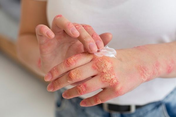 psoriasis - mujer aplicando un medicamento en forma de crema sobre su mano afectada por la psoriasis