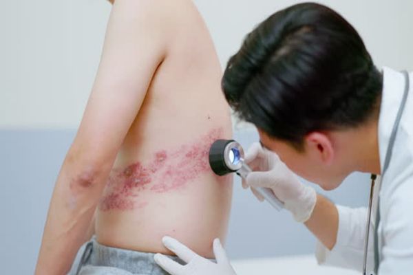 hombre joven en la consulta del dermatólogo, el cual esta haciendo la revisión de la zona afectada en por el virus el costado del paciente para dar un diagnostico