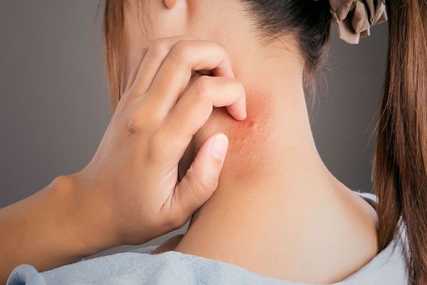 Lupus - mujer blanca joven con lesiones en la piel del cuero rascandose