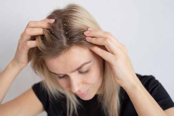 dermatitis seborreica - mujer blanca rubia con problemas de dermatitis seborreica como demuestran las escamas de piel en su pelo