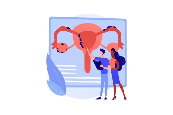 Endometriosis - Imagen referencial del crecimiento anormal del tejido en los órganos pélvicos, lo cual causa la endometriosis