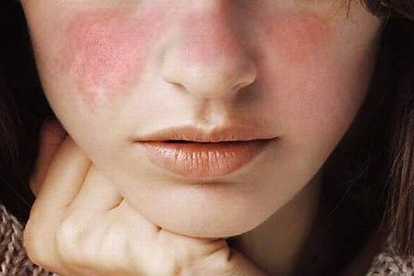 Lupus - primer plano de la zona media e inferior de la cara donde se ve una erupción malar en la zona de los pómulos y el dorso de la nariz