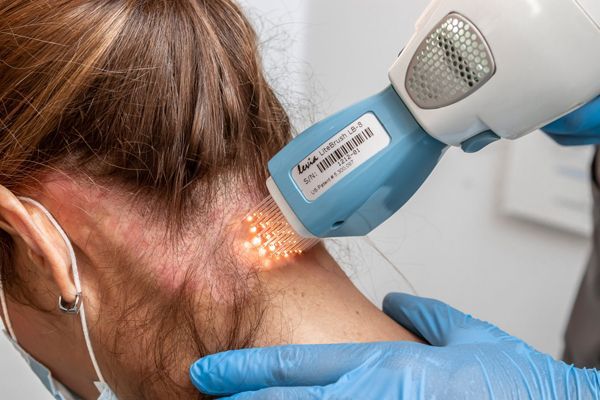 Mujer blanca en la consulta del especialista recibiendo un tratamiento de fototerapia en la parte posterior del cuello