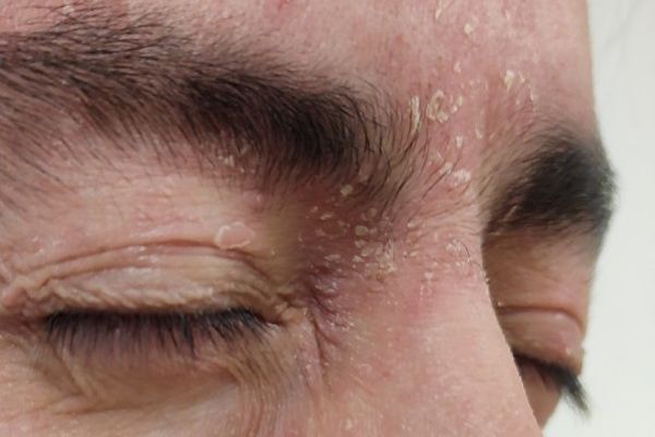 dermatitis seborreica - imagen del area de los ojos de un hombre blanco con las marcas que deja esta enfermedad