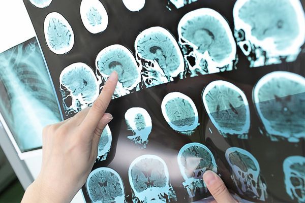 Esclerosis múltiple - especialista revisando los resultados de un escáner cerebral