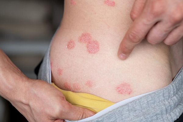 hombre mostrando los síntomas de la enfermedad que le han aparecido en la zona de las caderas
