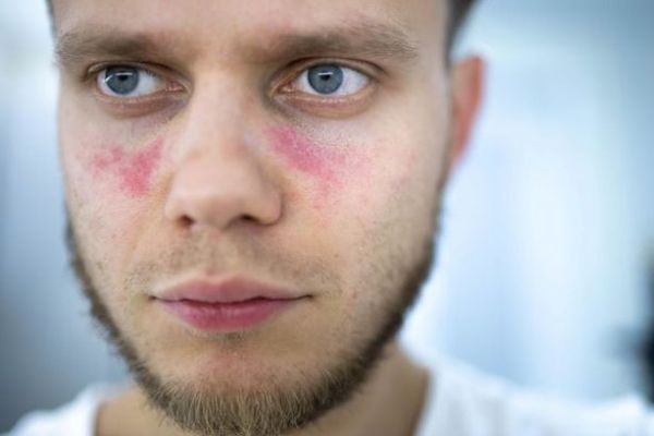 Lupus - hombre blanco joven con lesiones en la piel bajo la zona de sus ojos