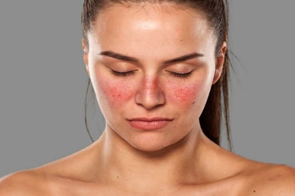 Lupus - mujer blanca con los ojos cerrados y lesiones de la piel en la zona de los pómulos y el dorso de la nariz