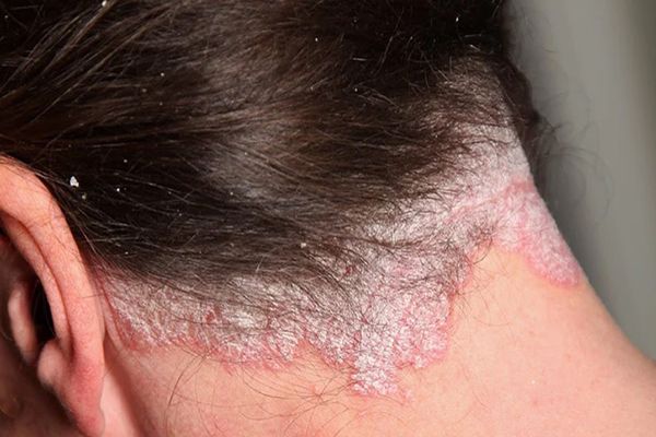imagen de la parte trasera del cuello de una mujer con fuertes síntomas de la enfermedad bajo la línea del cabello