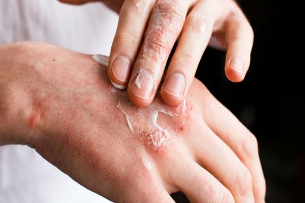 Sarna - persona adulta aplicando una crema en la zona afectada por la sarna de su mano
