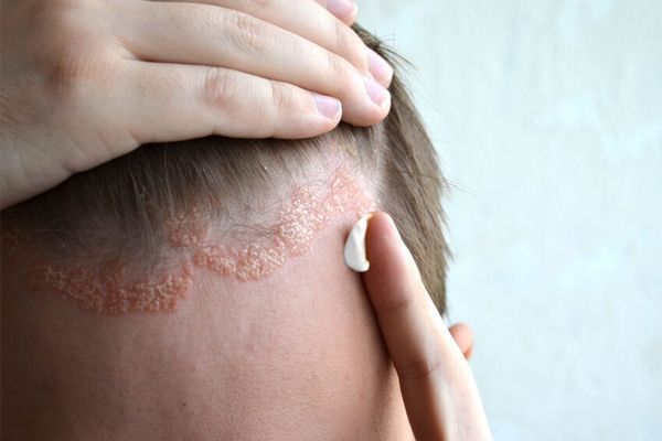 dermatitis seborreica - hombre blanco aplicándose una crema en la zona de la línea de cabello de la frente para tratar los síntomas de esta enfermedad