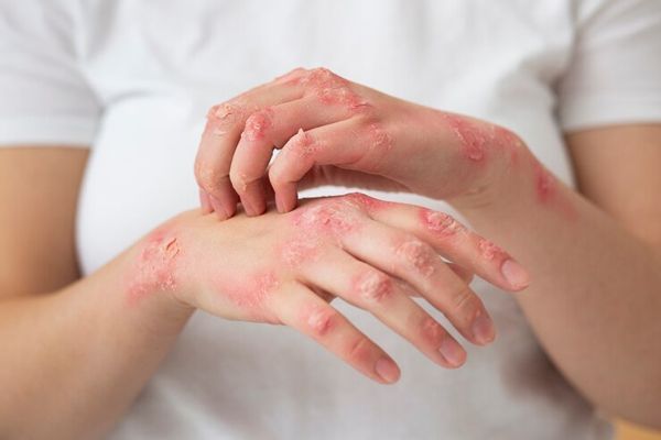 psoriasis - primer plano de las manos de una mujer afectada por psoriasis