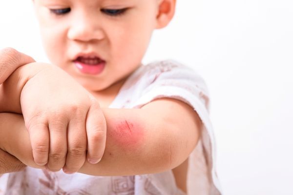 bebe con un eccema abierto en la piel por haber estado rascándose durante mucho tiempo
