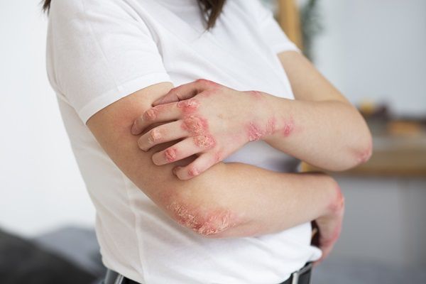 Esclerodermia - Mujer con síntomas de la afección después de exponerse a químicos agresivos, los cuales alteraron el nivel de colágeno en la piel