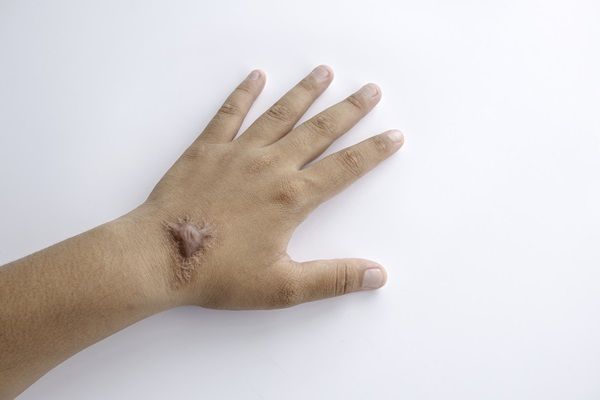 Esclerodermia - Foto de la mano de una mujer que sufre de esclerodermia, la cual presenta una cicatriz con engrosamiento de la piel que dificulta el movimiento