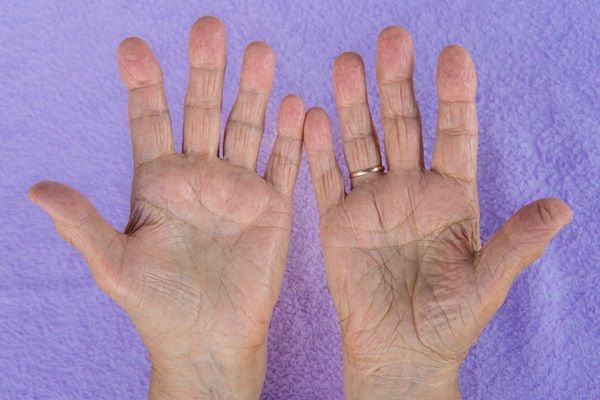Esclerodermia - Manos de una persona que sufre del fenómeno de Raynaud debido a la esclerosis sistémica, la cual ocasiona espasmos en los vasos sanguíneos de los dedos