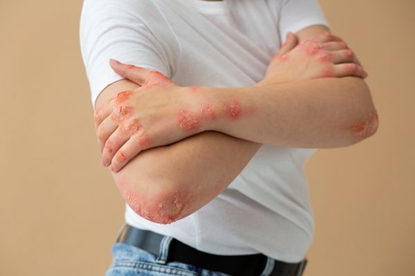 Dermatitis atópica - imagen del torso de un hombre con camiseta blanca y pantalones vaqueros que muestra los brazos con los síntomas de la dermatitis atópica