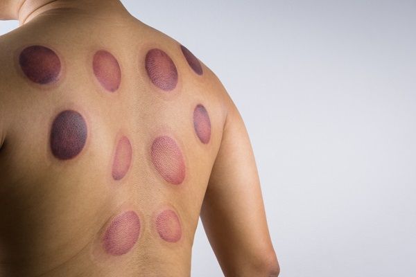 Tiña - Hombre con síntomas graves de la infección por hongos llamada tiña, la cual causa sarpullidos de forma circular en la piel