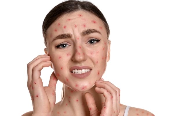 Viruela del mono - mujer con la cara y el cuerpo lleno de los síntomas en forma de erupciones de la enfermedad