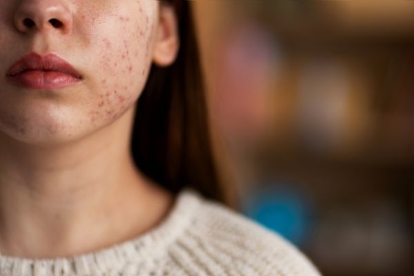 imagen del lateral de la cara de una mujer con el sarpullido característico de la enfermedad por el lado derecho de la cara