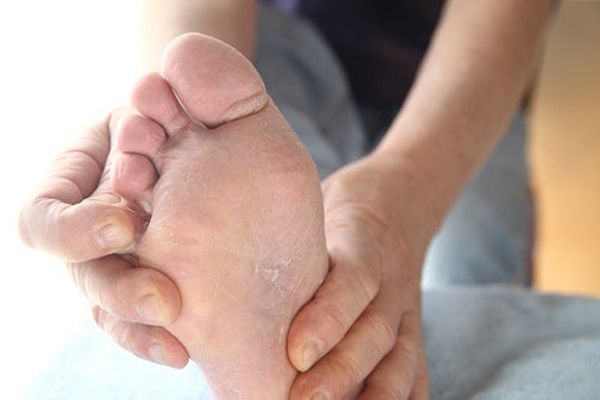 Pie de atleta - primer plano de los pies de un hombre con una infección de hongos