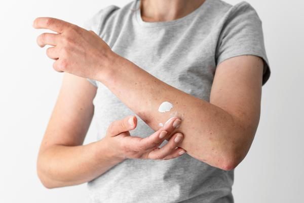 mujer adulta usando una medicamento de uso tópico para tratar los síntomas de la enfermedad