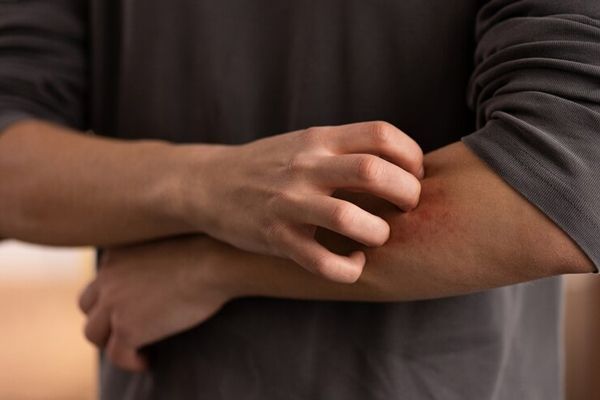 Sarna - joven rascándose la parte exterior del antebrazo cercana al codo por culpa del prurito