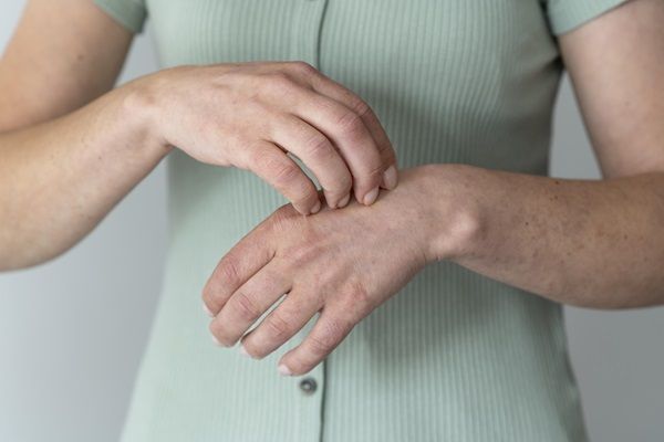 Esclerodermia - Mujer con síntomas de esclerosis sistémica, la cual causa tirantez y endurecimiento de la piel