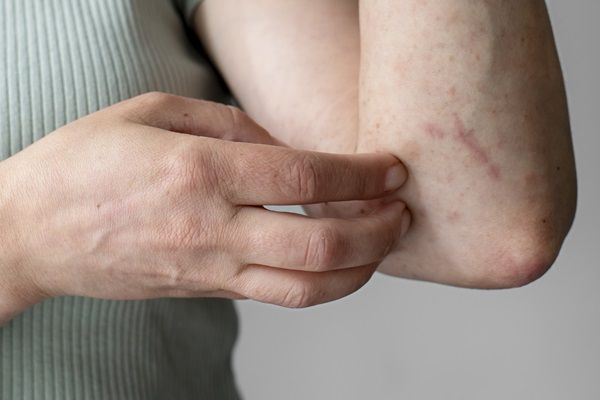Tiña - Mujer con síntomas de enrojecimiento y picazón en los brazos, causada por la infección fúngica llamada tinea corporis