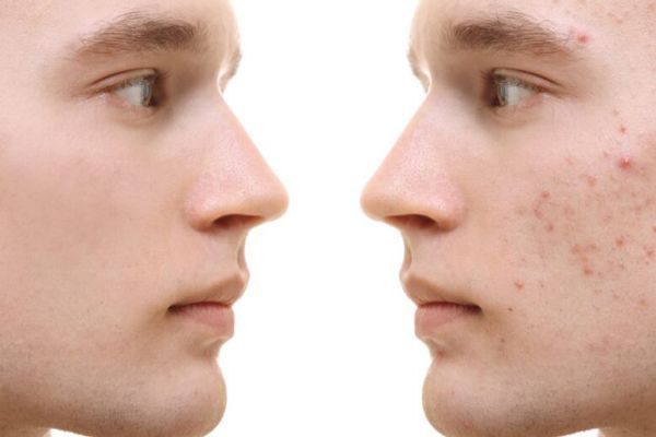 Acné - Imagen del rostro de un joven antes y después del acné