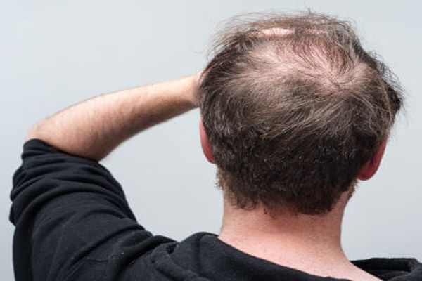 Alopecia - Hombre de espaldas con signos claros de alopecia en la coronilla pasándose la mano por la cabeza