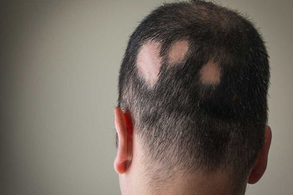 Alopecia por estrés - Parte trasera de la cabeza con parches en el cuero cabelludo por alopecia areata 