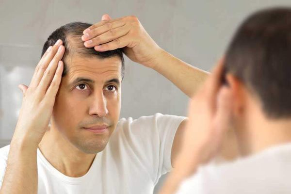 Alopecia por estrés - Hombre delante del espejo preocupado por la aparición de claros en el cuero cabelludo 