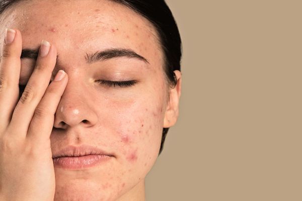 Acné - mujer joven preocupada por la gran cantidad acné en su cara