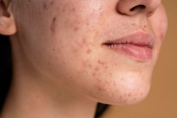 Acné - joven con cicatrices causada por el acné