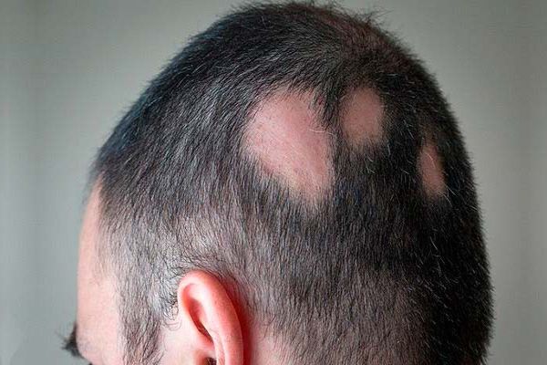 Alopecia - Parte trasera de la cabeza de un hombre con parches en el cuero cabelludo 