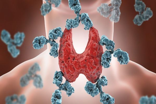 Hipotiroidismo - dibujo 3D de la tiroides enferma de la Tiroiditis de Hashimoto 