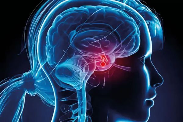 Hipotiroidismo - Dibujo en 3D del cerebro de un mujer con un trastorno en la hipófisis 