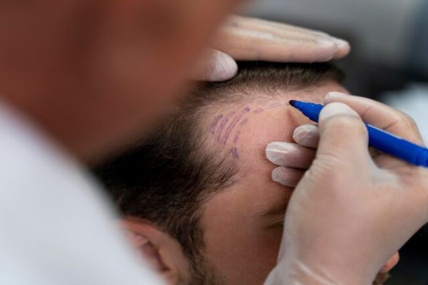 hombre en la consulta del tricólogo el cual esta diseñando el Injerto capilar con técnica FUE 