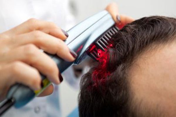 hombre sometiéndose a una terapia Láser capilar para la calvicie 