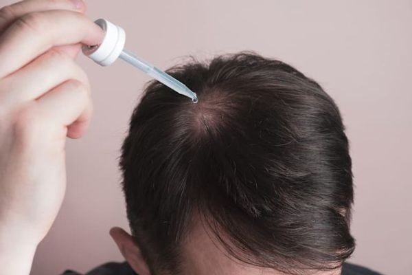 Hombre aplicando Minoxidil tópico para la alopecia en la zona de la coronilla