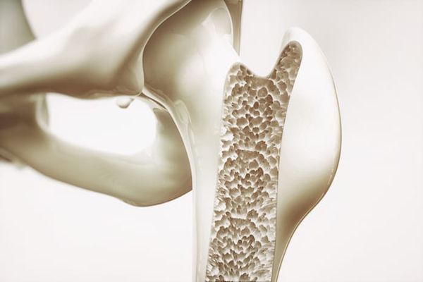 Hipertiroidismo - Dibujo de a cabeza del humero con síntomas de osteoporosis