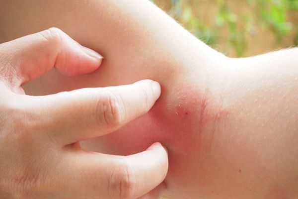 Alergias - Mujer rascándose la parte interior del codo por la picadura de un insecto que le ha producido un proceso alérgico 
