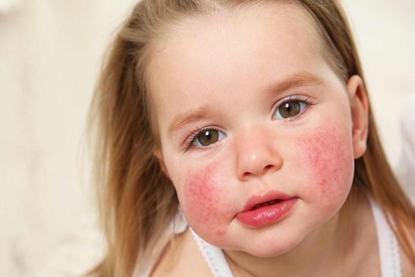 Alergias - Niña con dermatitis atópica en los mofletes causada por un ataque de alergia
