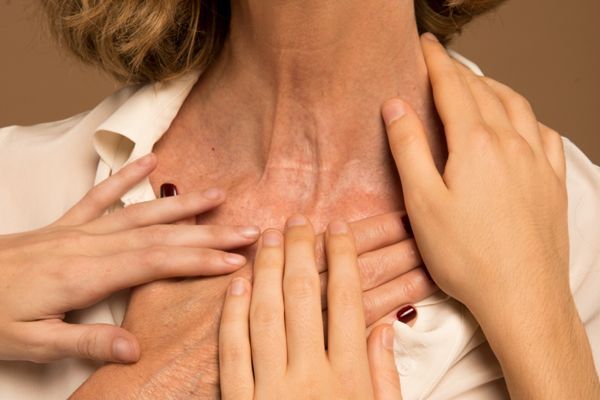Mujer mayor llevándose la mano al cuello por problemas de la tiroides