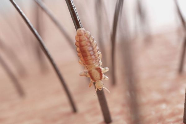 Pediculosis - Piojo adulto caminando por el cabello