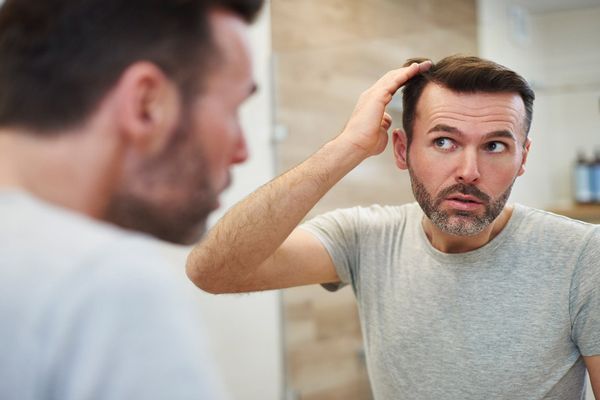 Alopecia - Hombre revisándose las entradas del cabello frente al espejo 