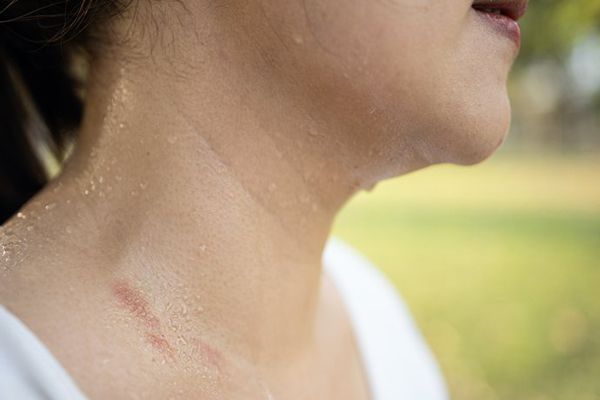 Hiperhidrosis - imagen del cuello de una mujer con exceso de sudoración con signos de infecciones en varias partes del cuello