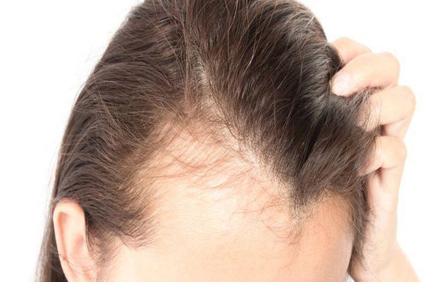 Alopecia por estrés - mujer mostrando los problemas causados por el efluvio telógeno femenino